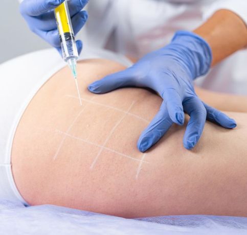 Mesoterapia reducción de celulitis